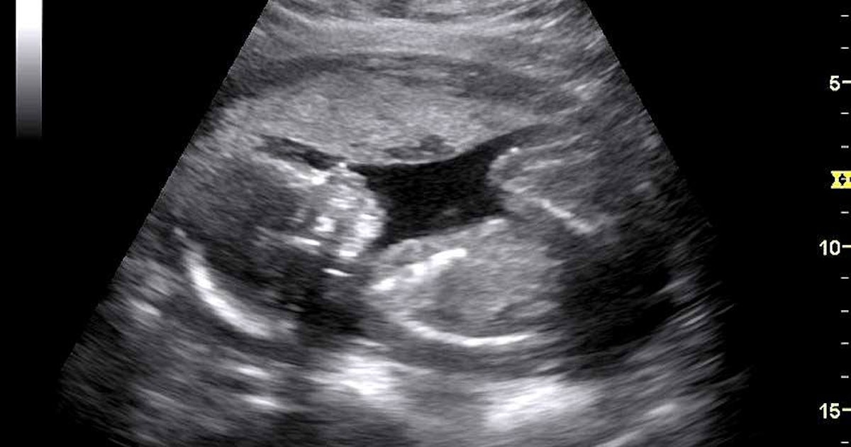 Know everything that you can do with a fake sonogram!